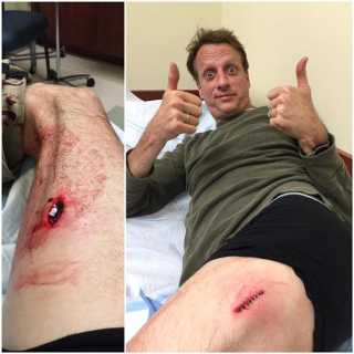 Illustration for article titled What Was This Thing Sticking Out Of Tony Hawk's Thigh?